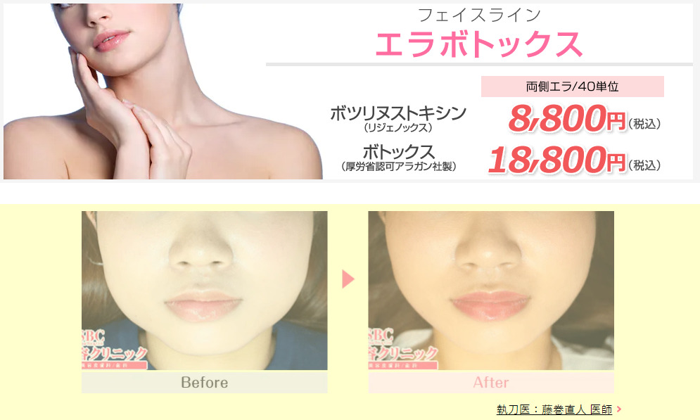 神戸でエラボトックスがおすすめのクリニック8選 エラボトックスの効果やデメリットを紹介 Beauty Success