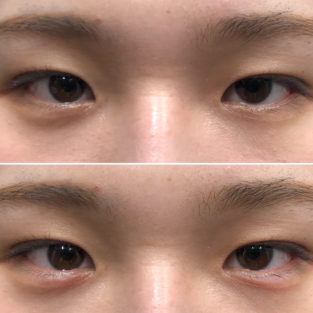 涙袋ヒアルロン酸【２０代】【女性】