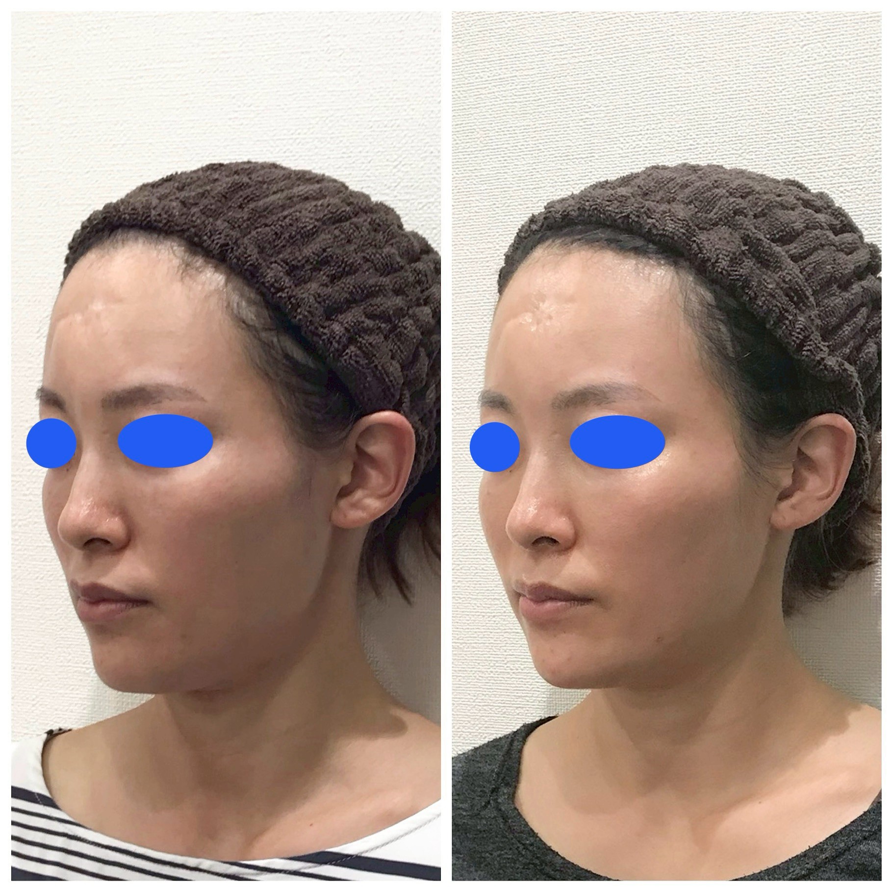 ヒアルロン酸小顔カスタマイズ【30代/女性】