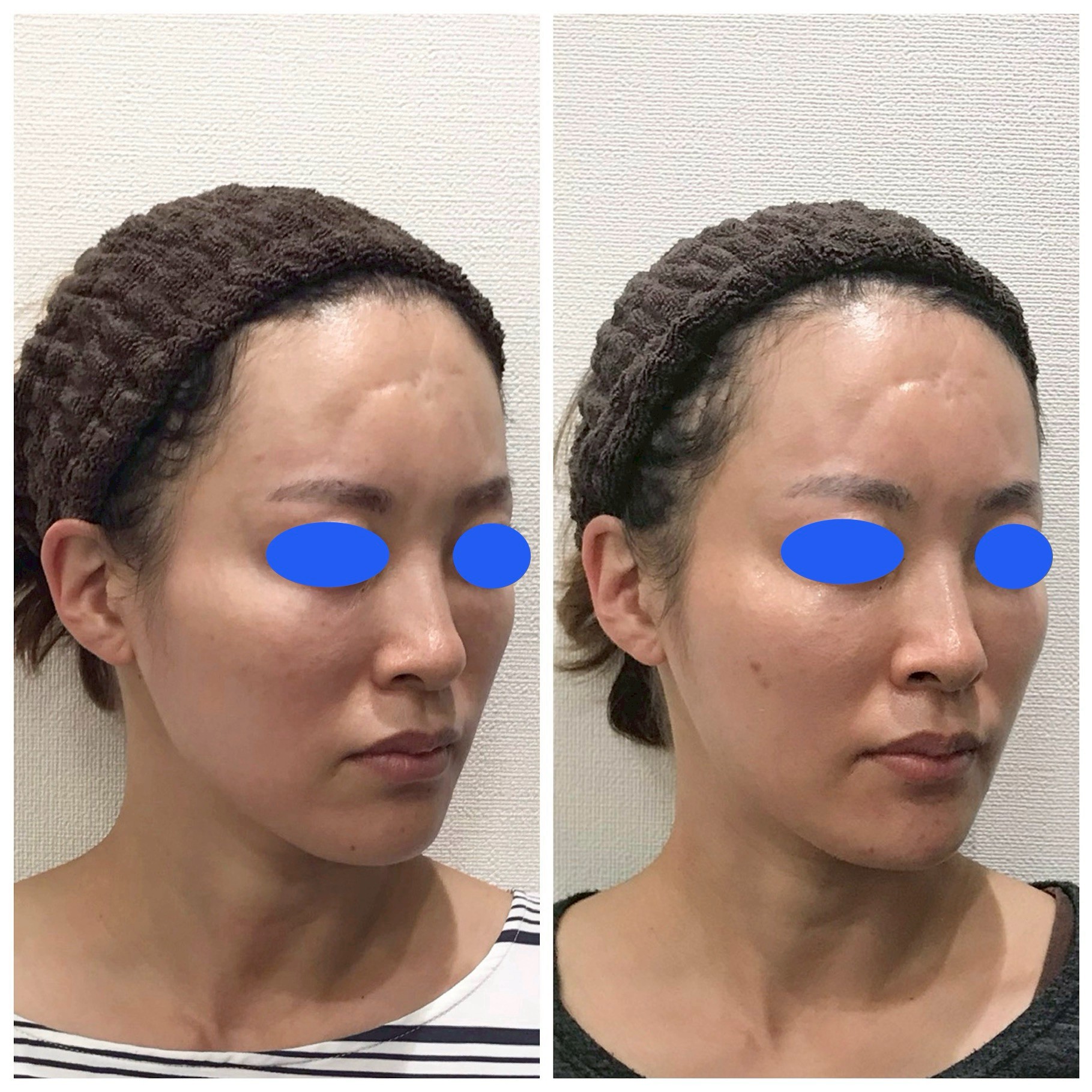 ヒアルロン酸小顔カスタマイズ【30代/女性】