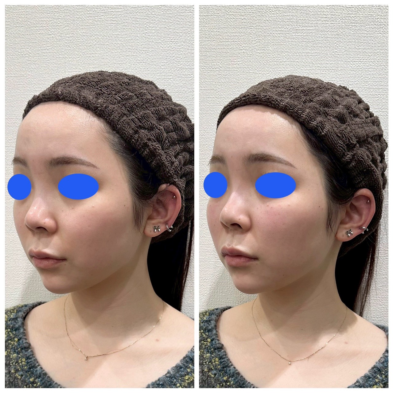 ヒアルロン酸小顔カスタマイズ【20代/女性】